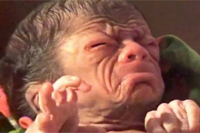 4 milyonda bir görülen ’Progeria’ hastalığı