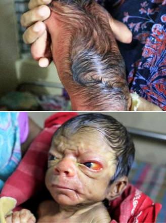 4 milyonda bir görülen ’Progeria’ hastalığı