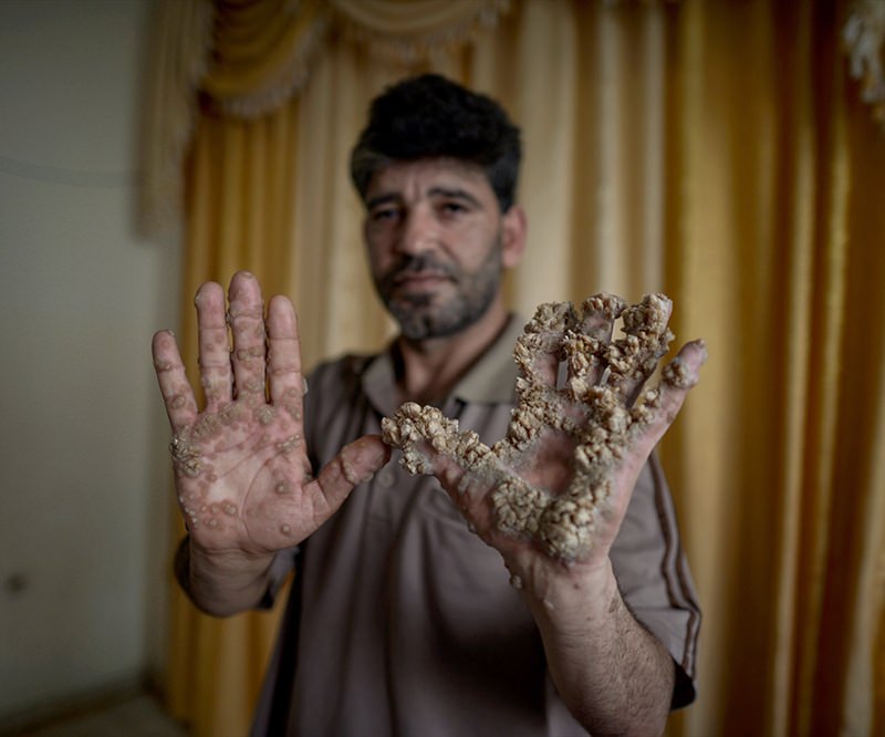 Ağaç adam ameliyat olmayı bekliyor!