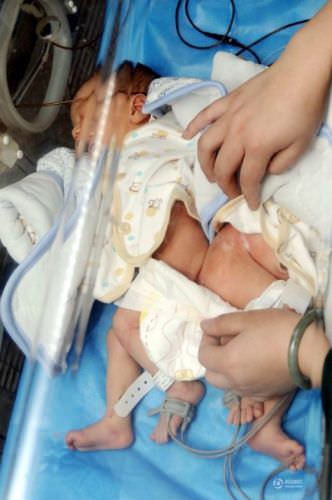 Böyle ikiz görülmedi