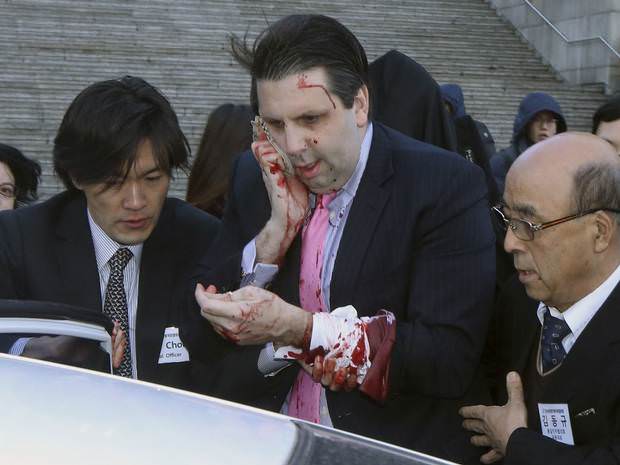 Usturalı saldırı sonrası taburcu oldu