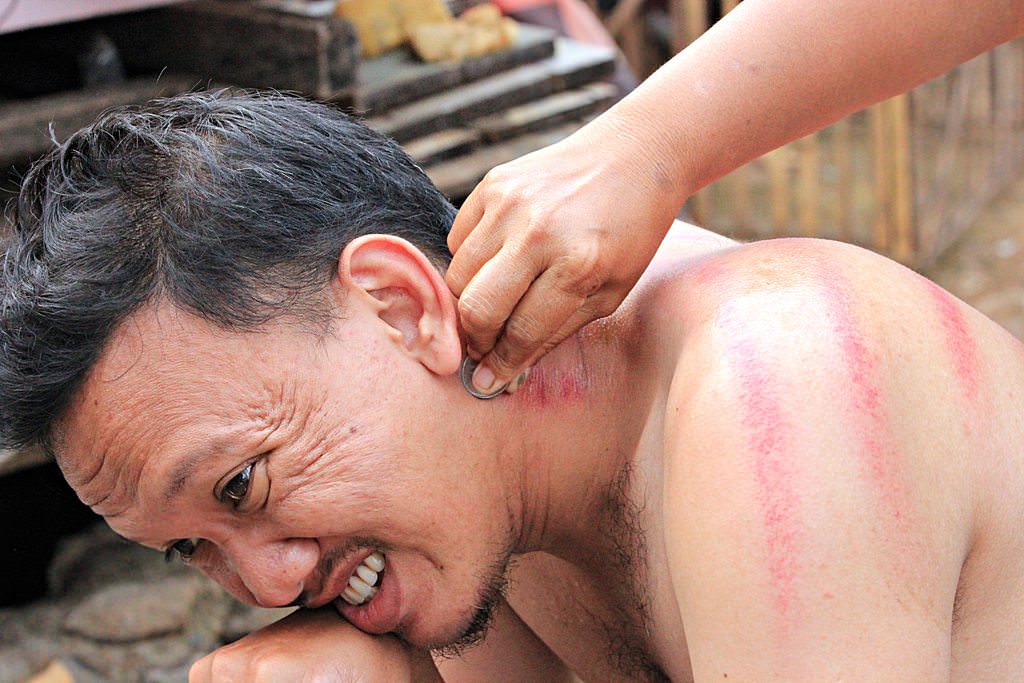 Endonezya’da garip bir tedavi yöntemi