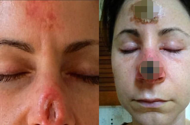 O ilaçtan sonra burnu çürümeye başladı