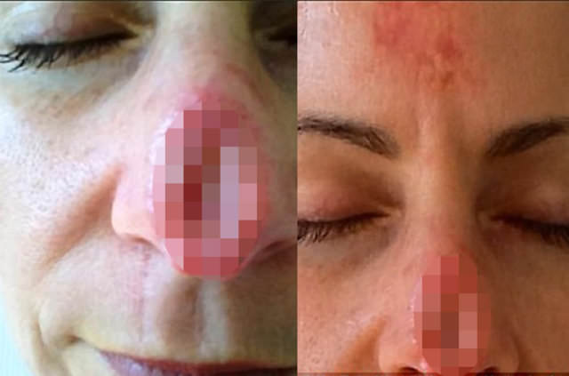 O ilaçtan sonra burnu çürümeye başladı