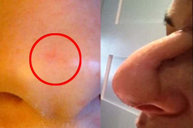 O ilaçtan sonra burnu çürümeye başladı