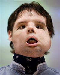 ilk tam y�z nakli �spanya ameliyat oscar Barcelona