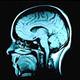Alzheimera �are mi?