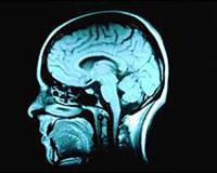 Alzheimer'a �are mi?