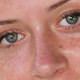 Y�zdeki k�rm�z� lekelere lazerli ��z�m