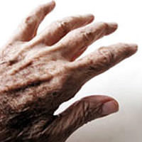 Parkinson
